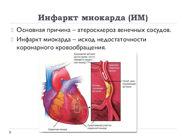 Инфаркт миокарда (ИМ) Основная причина – атеросклероз венечных сосудов. Инфаркт миокарда – исход недостаточности коронарного кровообращения.