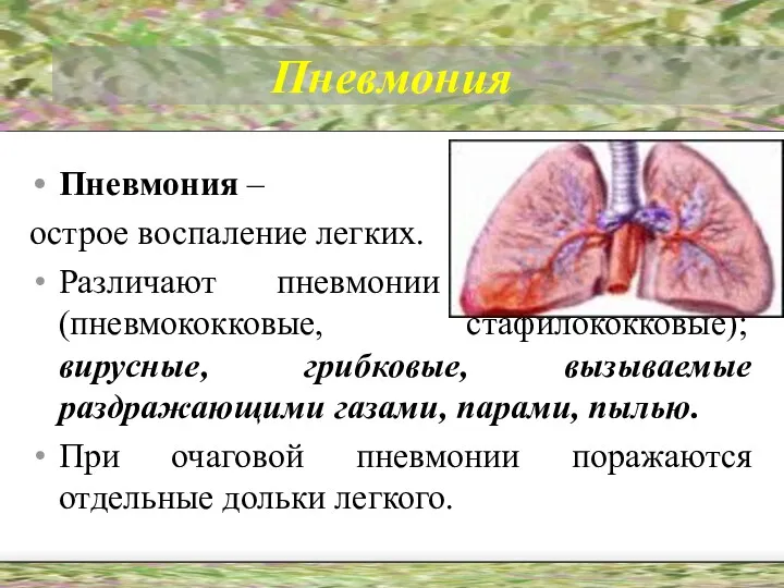 Пневмония Пневмония – острое воспаление легких. Различают пневмонии бактериальные (пневмококковые, стафилококковые); вирусные, грибковые,
