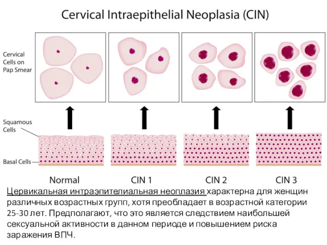 Цервикальная интраэпителиальная неоплазия характерна для женщин различных возрастных групп, хотя