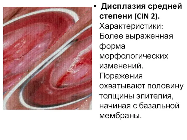 Дисплазия средней степени (CIN 2). Характеристики: Более выраженная форма морфологических