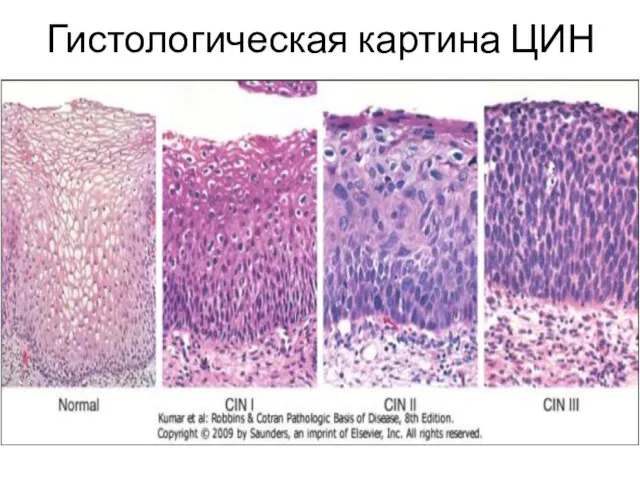 Гистологическая картина ЦИН