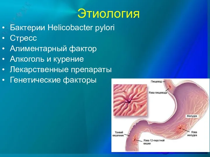 Этиология • Бактерии Helicobacter pylori • Стресс • Алиментарный фактор