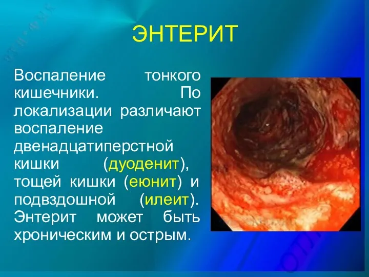 ЭНТЕРИТ Воспаление тонкого кишечники. По локализации различают воспаление двенадцатиперстной кишки