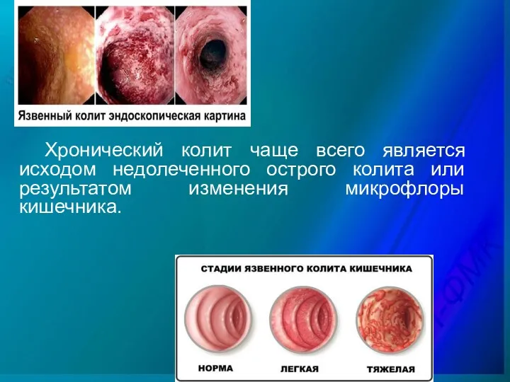 Хронический колит чаще всего является исходом недолеченного острого колита или результатом изменения микрофлоры кишечника.