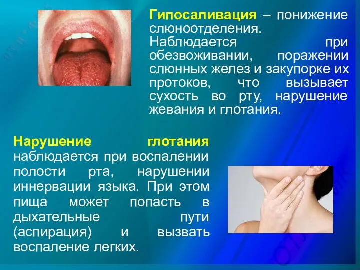 Нарушение глотания наблюдается при воспалении полости рта, нарушении иннервации языка.