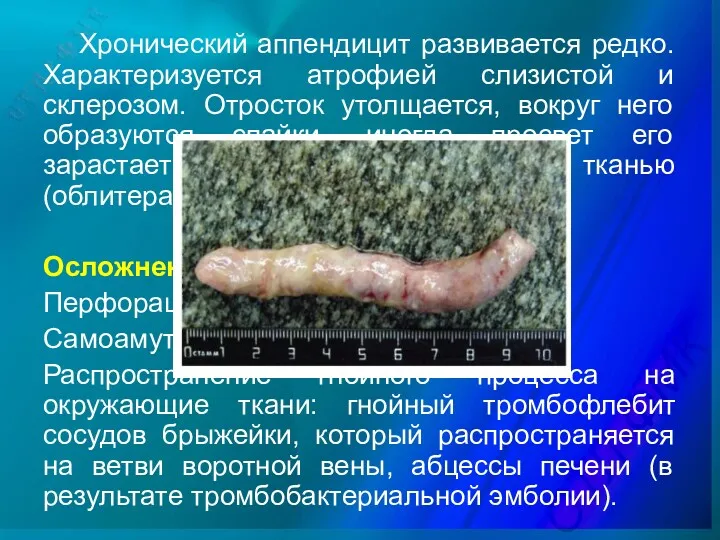 Хронический аппендицит развивается редко. Характеризуется атрофией слизистой и склерозом. Отросток