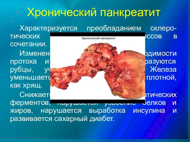 Хронический панкреатит Характеризуется преобладанием склеро-тических и атрофических процессов в сочетании.