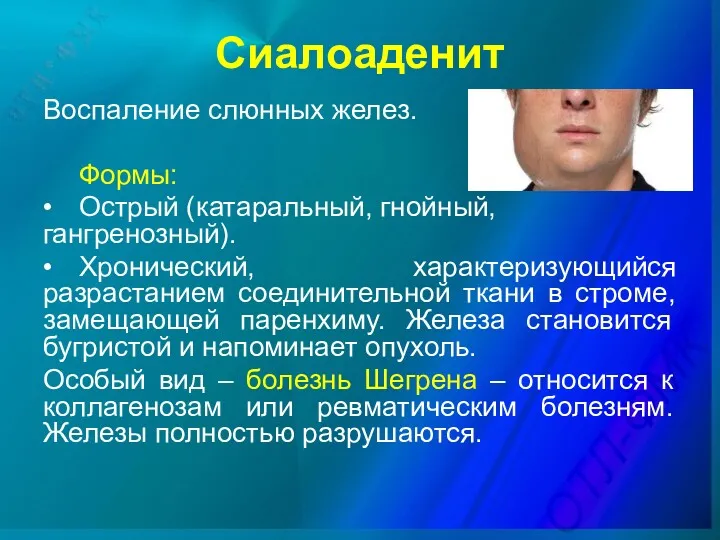 Сиалоаденит Воспаление слюнных желез. Формы: • Острый (катаральный, гнойный, гангренозный).