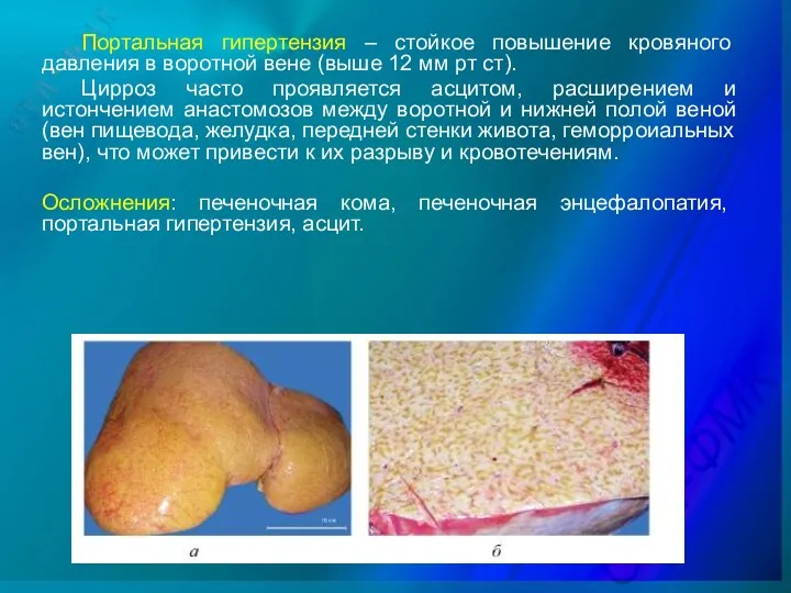 Портальная гипертензия – стойкое повышение кровяного давления в воротной вене