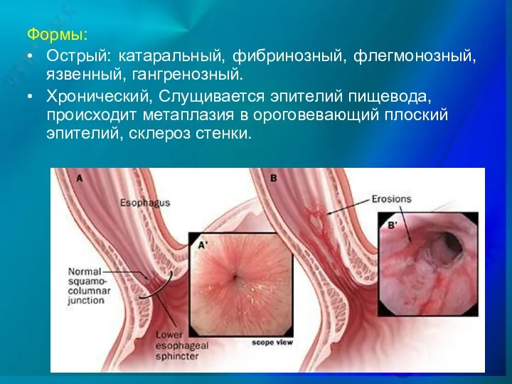 Формы: • Острый: катаральный, фибринозный, флегмонозный, язвенный, гангренозный. • Хронический,