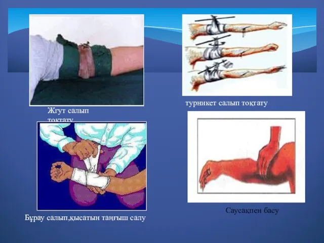 Жгут салып тоқтату турникет салып тоқтату Бұрау салып,қысатын таңғыш салу Саусақпен басу