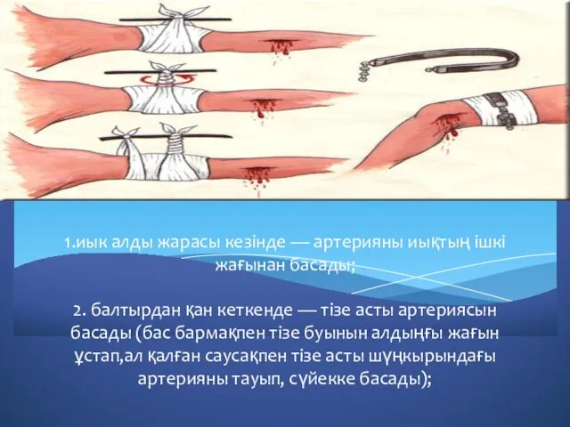 1.иык алды жарасы кезінде — артерияны иықтың ішкі жағынан басады;