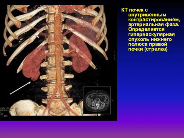 КТ почек с внутривенным контрастированием, артериальная фаза. Определяется гиперваскулярная опухоль нижнего полюса правой почки (стрелка)