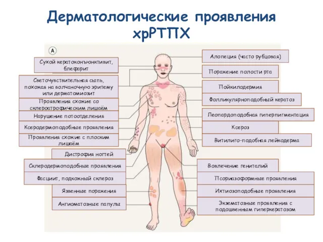 Дерматологические проявления хрРТПХ Алопеция (часто рубцовая) Поражение полости рта Пойкилодермия