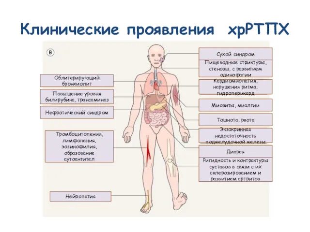 Клинические проявления хрРТПХ Сухой синдром Пищеводные стриктуры, стенозы, с развитием