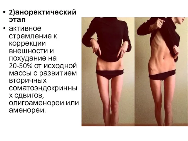 2)аноректический этап активное стремление к коррекции внешности и похудание на 20-50% от исходной