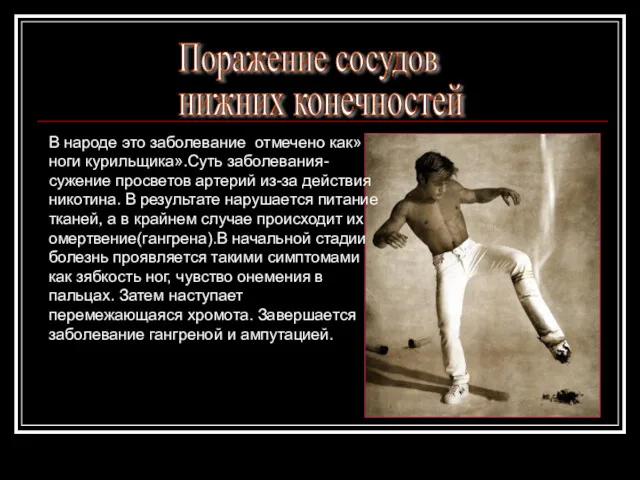 Поражение сосудов нижних конечностей В народе это заболевание отмечено как»ноги