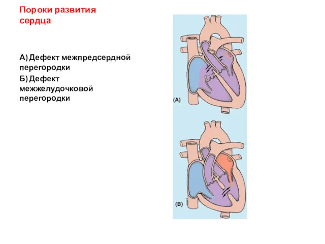 Пороки развития сердца А) Дефект межпредсердной перегородки Б) Дефект межжелудочковой перегородки