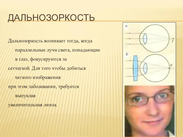 Дальнозоркость возникает тогда, когда параллельные лучи света, попадающие в глаз,