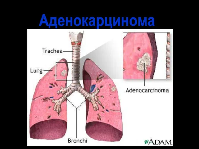 Аденокарцинома