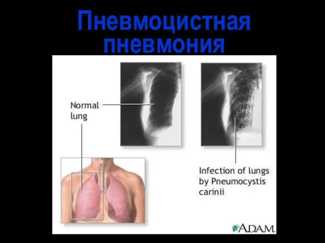 Пневмоцистная пневмония