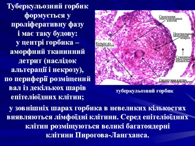 Туберкульозний горбик формується у проліферативну фазу і має таку будову: