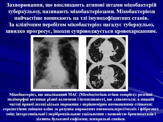 Захворювання, що викликають атипові штами мікобактерій туберкульозу, називають мікобактеріозами. Мікобактеріози