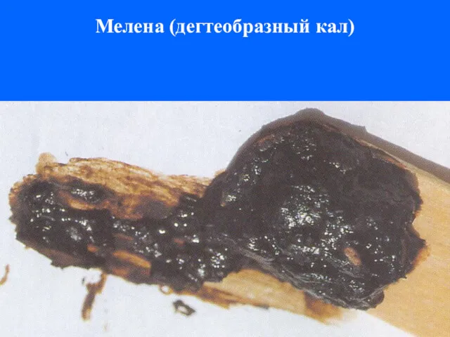 Мелена (дегтеобразный кал)