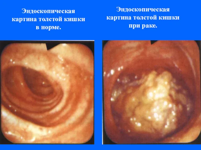 Эндоскопическая картина толстой кишки в норме. Эндоскопическая картина толстой кишки при раке.