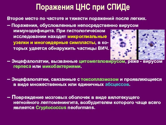 Поражения ЦНС при СПИДе Второе место по частоте и тяжести