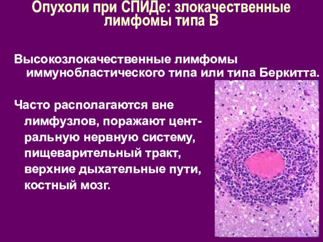 Опухоли при СПИДе: злокачественные лимфомы типа В Высокозлокачественные лимфомы иммунобластического