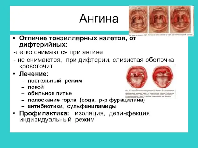 Ангина Отличие тонзиллярных налетов, от дифтерийных: -легко снимаются при ангине - не снимаются,