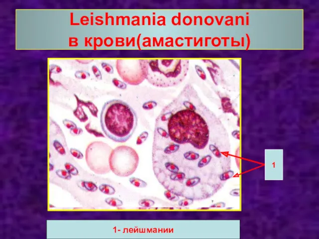 Leishmania donovani в крови(амастиготы) 1 1- лейшмании
