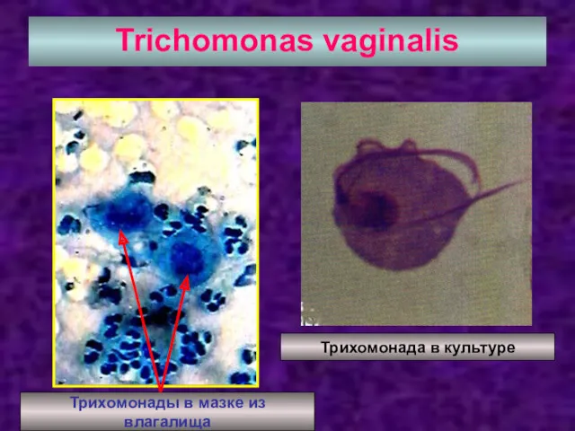 Trichomonas vaginalis Трихомонады в мазке из влагалища Трихомонада в культуре