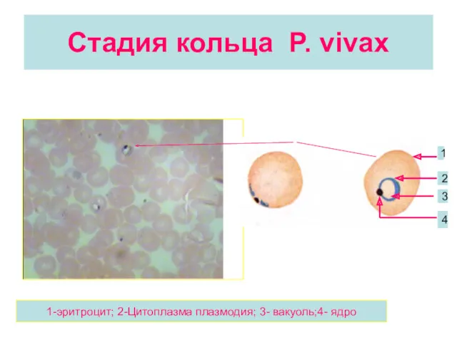 Стадия кольца P. vivax 1 2 3 4 1-эритроцит; 2-Цитоплазма плазмодия; 3- вакуоль;4- ядро