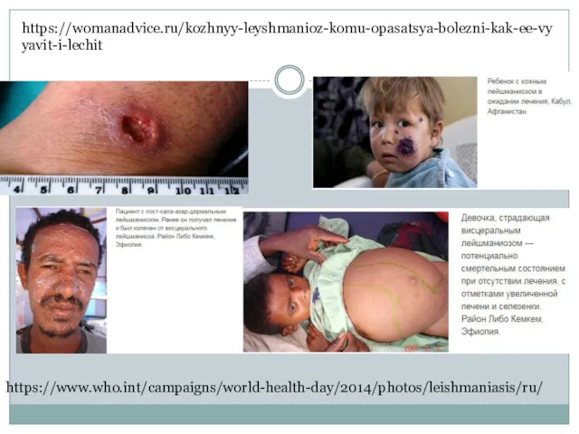 https://womanadvice.ru/kozhnyy-leyshmanioz-komu-opasatsya-bolezni-kak-ee-vyyavit-i-lechit https://www.who.int/campaigns/world-health-day/2014/photos/leishmaniasis/ru/