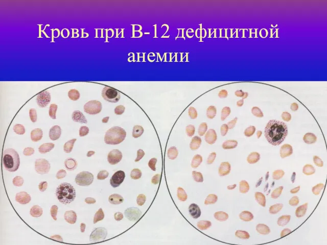 Кровь при В-12 дефицитной анемии