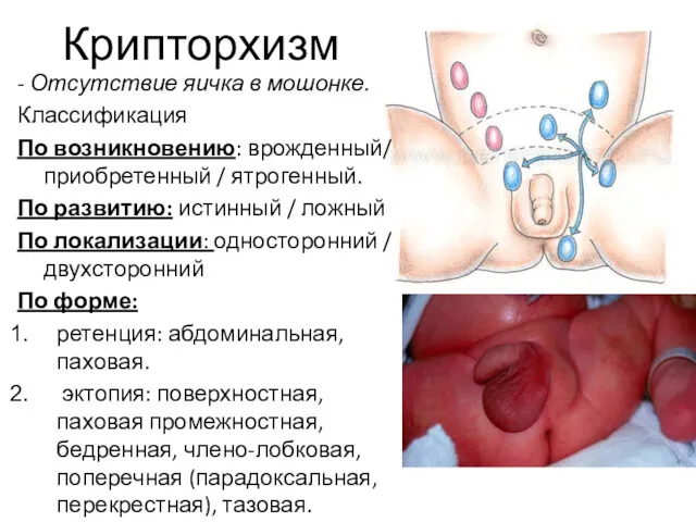 Крипторхизм - Отсутствие яичка в мошонке. Классификация По возникновению: врожденный/