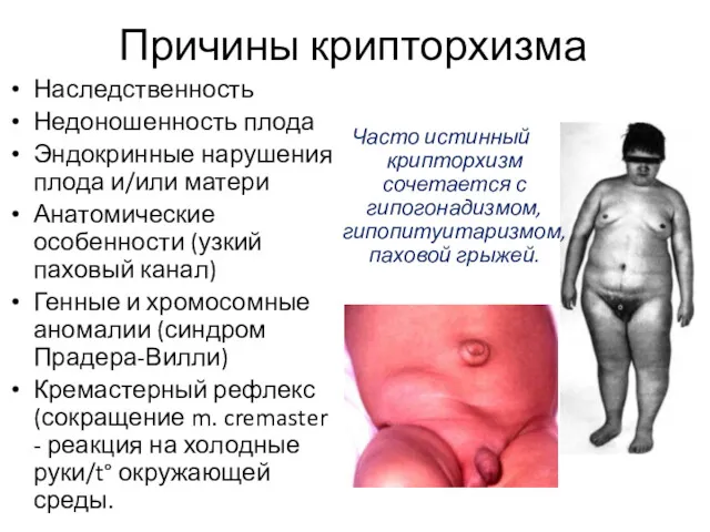 Наследственность Недоношенность плода Эндокринные нарушения плода и/или матери Анатомические особенности