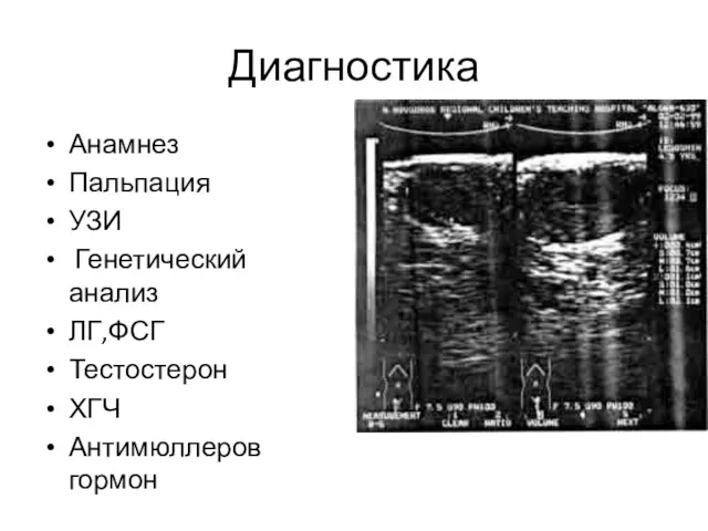 Диагностика Анамнез Пальпация УЗИ Генетический анализ ЛГ,ФСГ Тестостерон ХГЧ Антимюллеров гормон