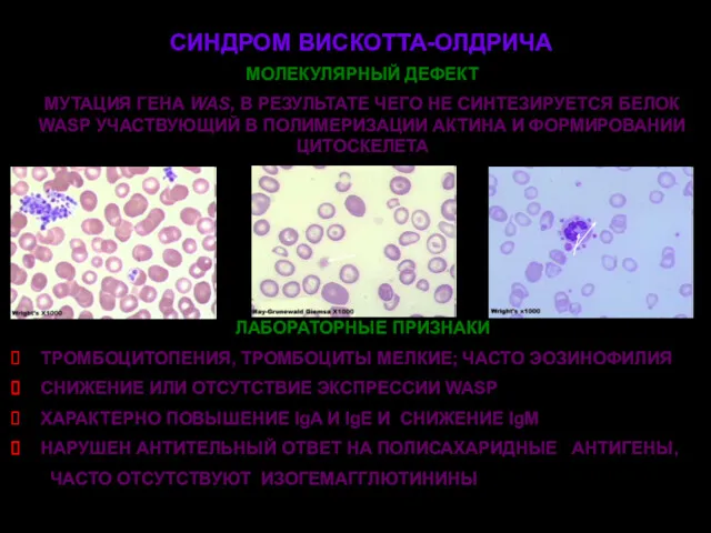 СИНДРОМ ВИСКОТТА-ОЛДРИЧА МОЛЕКУЛЯРНЫЙ ДЕФЕКТ МУТАЦИЯ ГЕНА WAS, В РЕЗУЛЬТАТЕ ЧЕГО