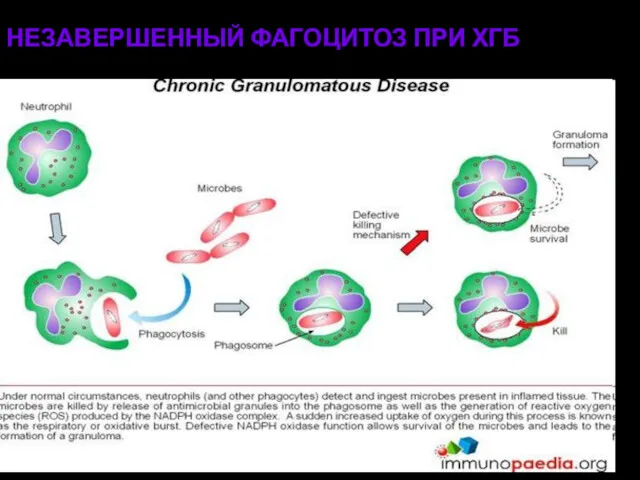 НЕЗАВЕРШЕННЫЙ ФАГОЦИТОЗ ПРИ ХГБ