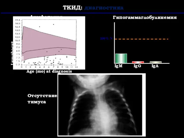 ТКИД: диагностика Гипогаммаглобулинемия