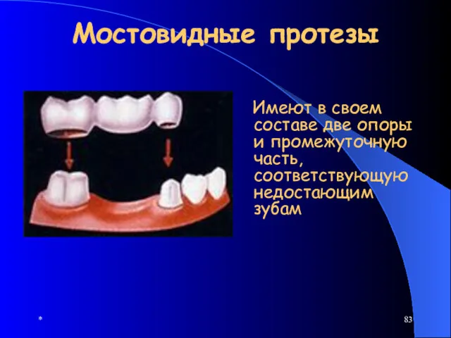 * Мостовидные протезы Имеют в своем составе две опоры и промежуточную часть, соответствующую недостающим зубам