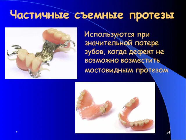 * Частичные съемные протезы Используются при значительной потере зубов, когда дефект не возможно возместить мостовидным протезом