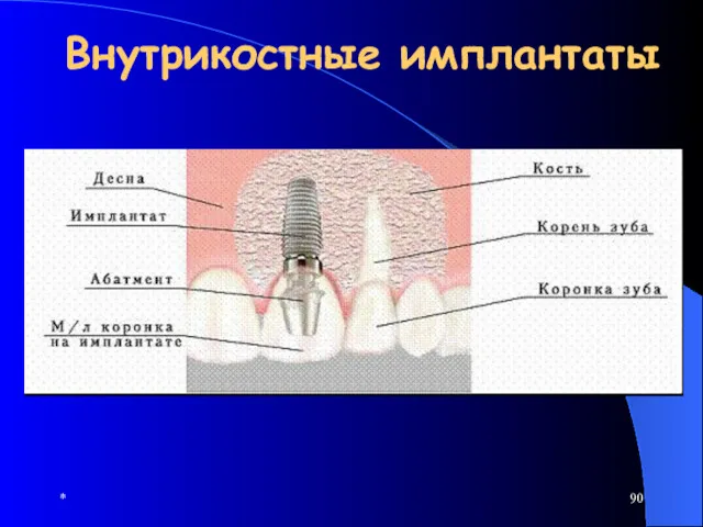 * Внутрикостные имплантаты