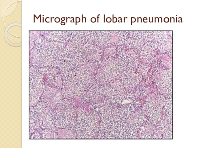Micrograph of lobar pneumonia