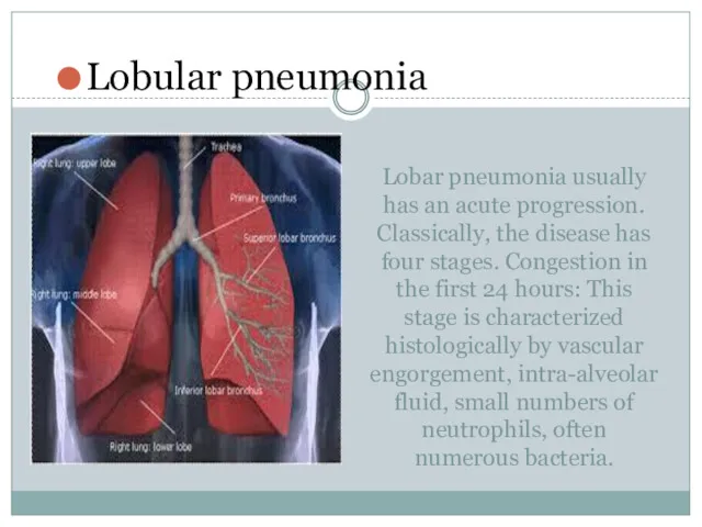 Lobar pneumonia usually has an acute progression. Classically, the disease