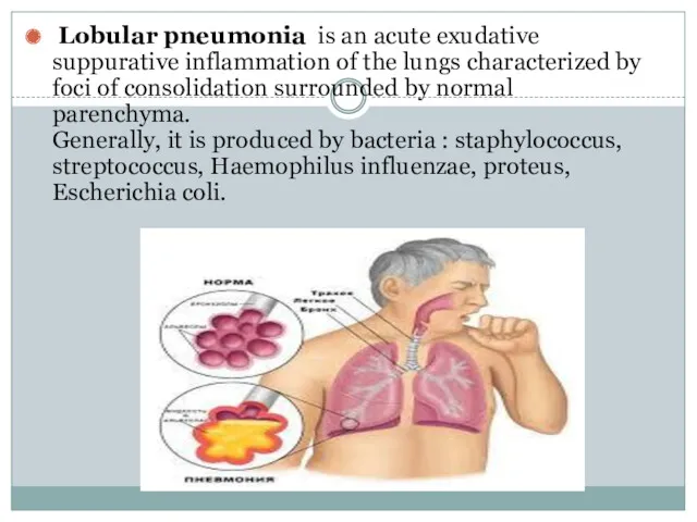 Lobular pneumonia is an acute exudative suppurative inflammation of the