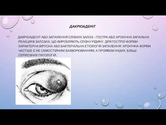 ДАКРІОАДЕНІТ ДАКРІОАДЕНІТ АБО ЗАПАЛЕННЯ СЛІЗНИХ ЗАЛОЗ – ГОСТРА АБО ХРОНІЧНА